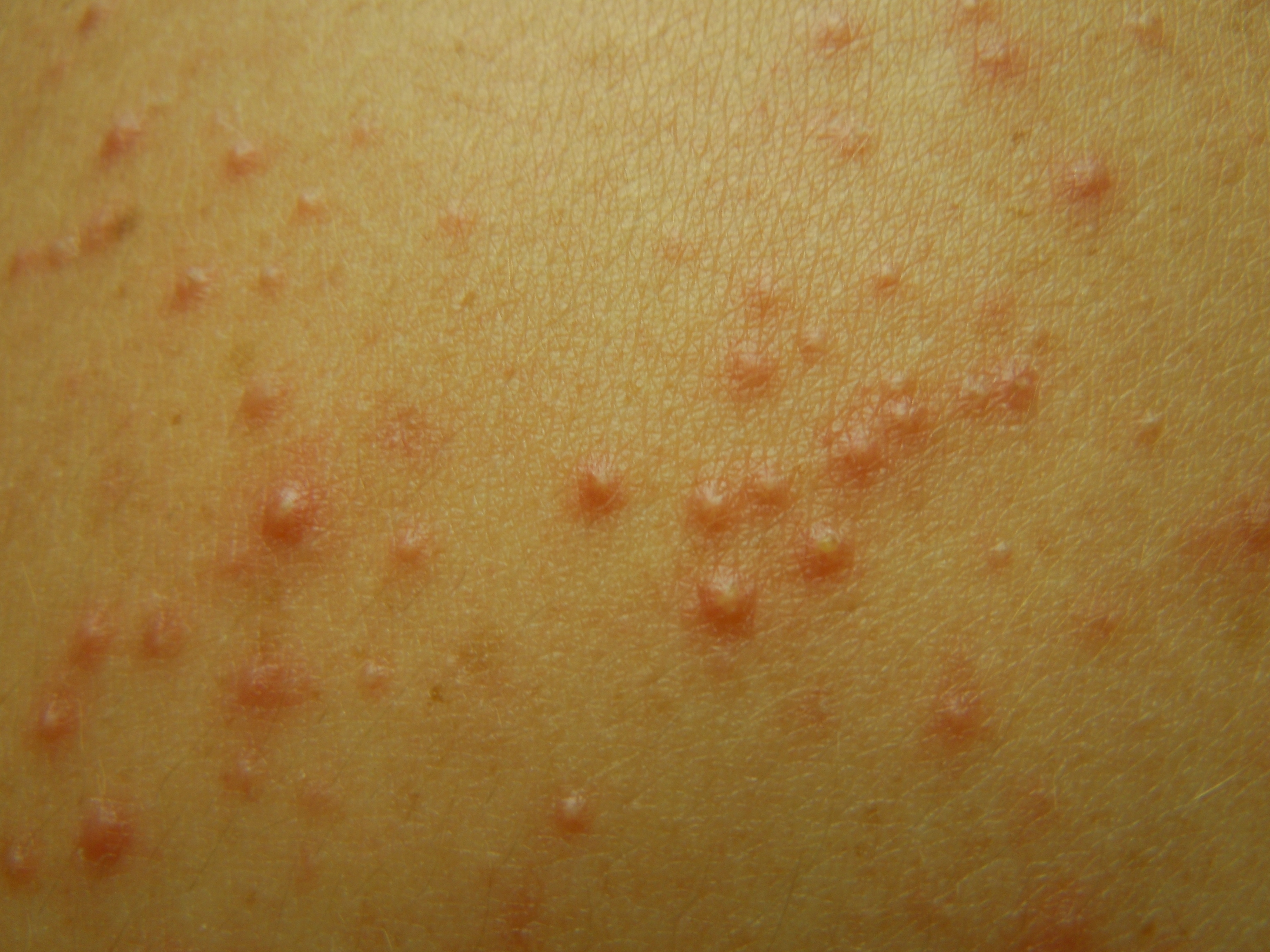 Folliculitis